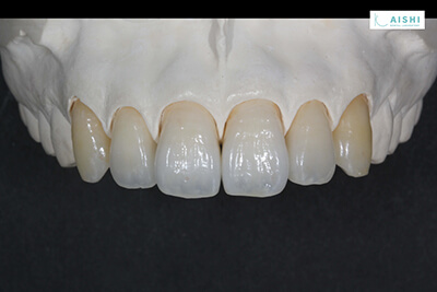 白い歯の治療